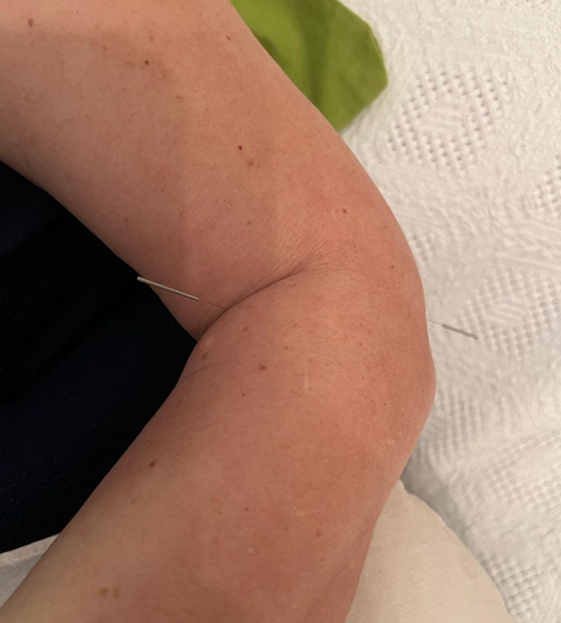 Acupuntura Avanzada Madrid 19