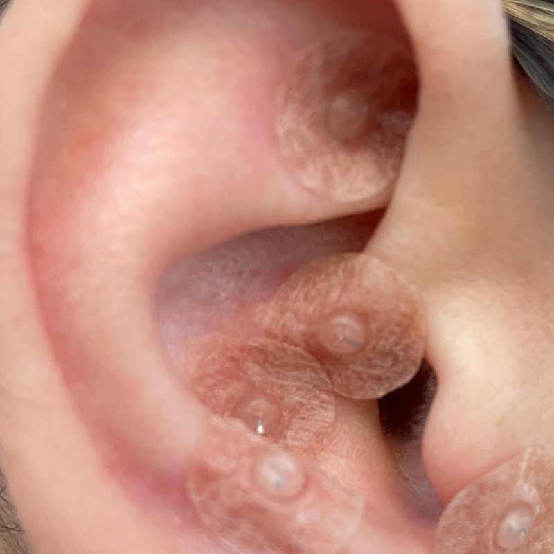 Acupuntura Avanzada Madrid 12