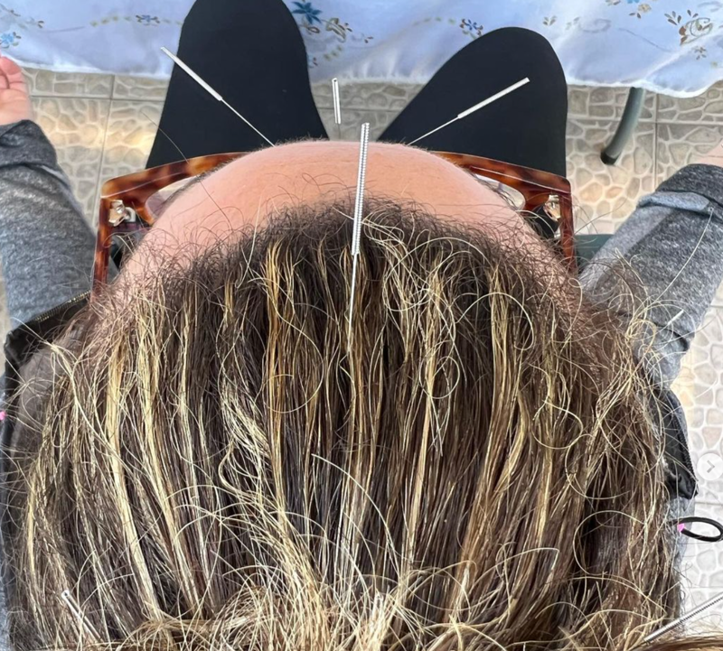 Acupuntura Avanzada Madrid 18