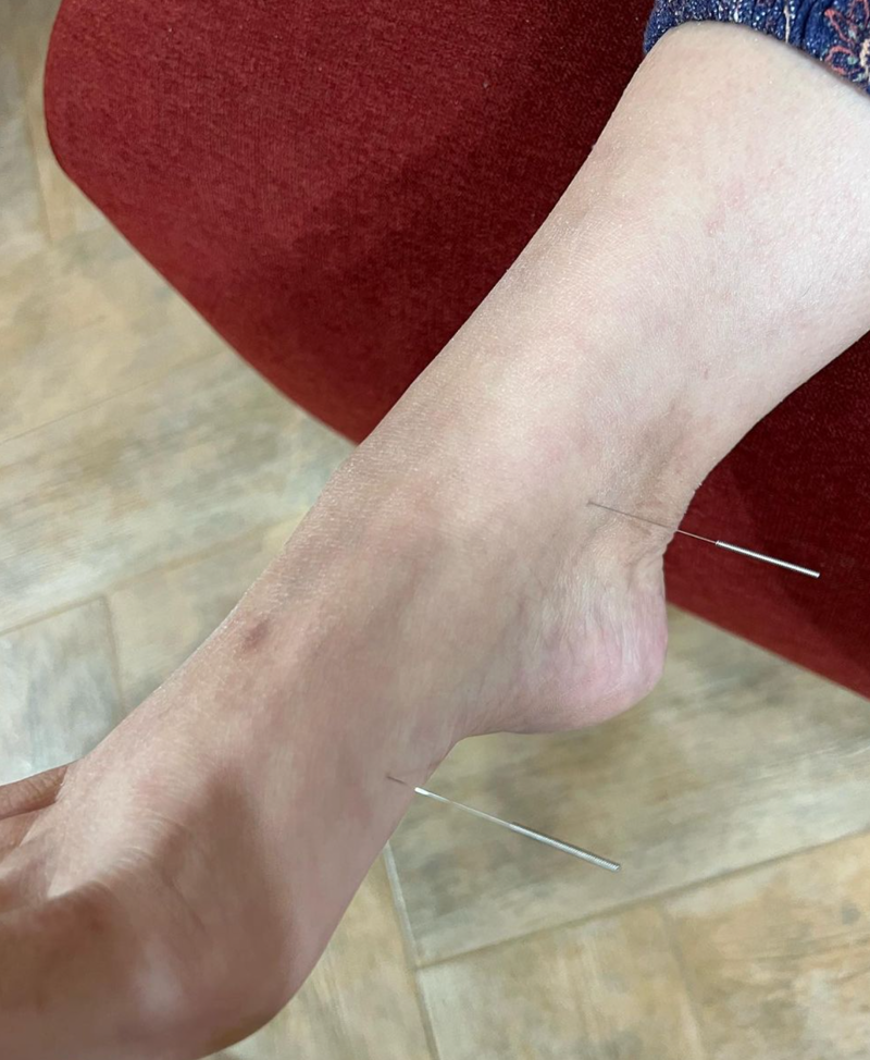 Acupuntura Avanzada Madrid 13