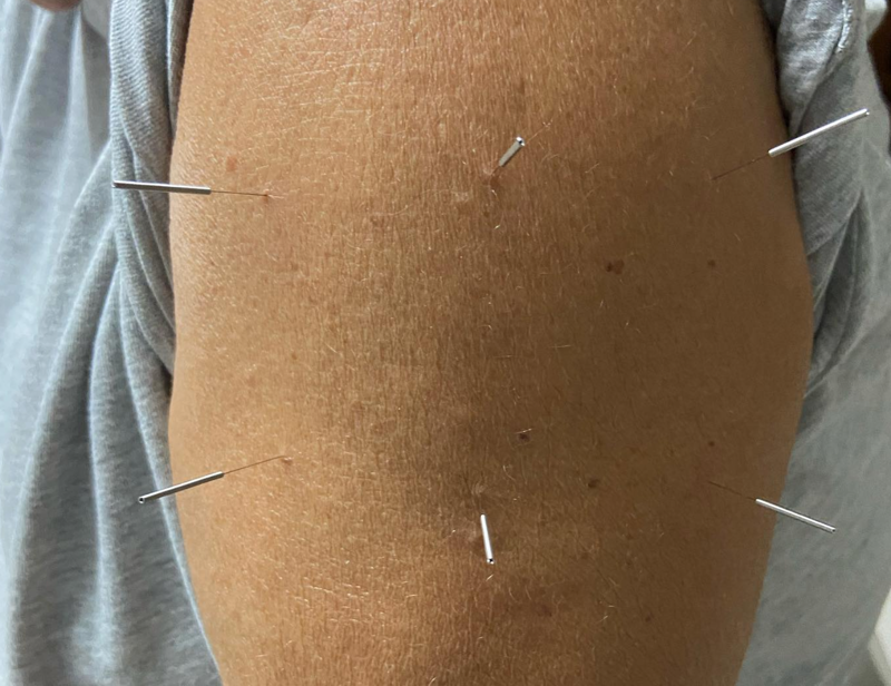 Acupuntura Avanzada Madrid 6