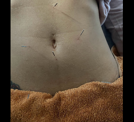 Acupuntura Avanzada Madrid 2