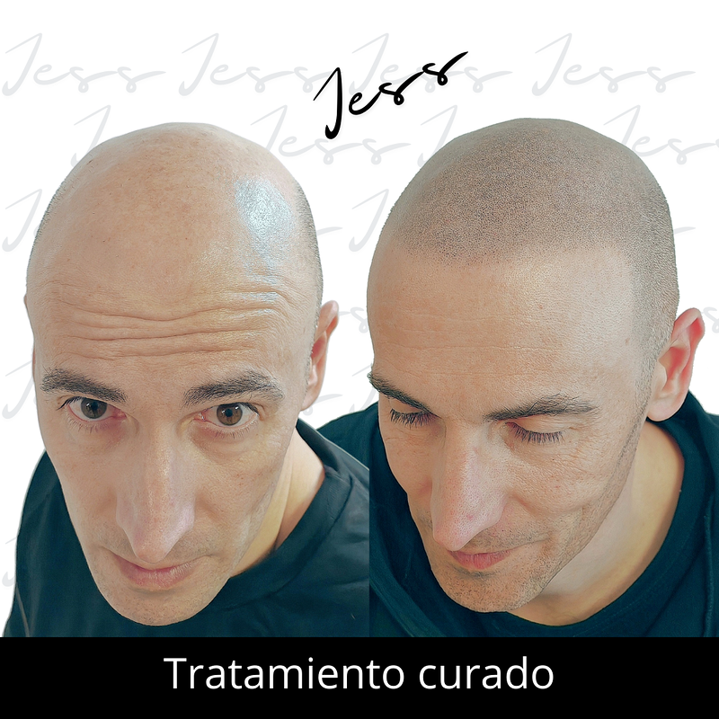 Jess Microcapilar 14