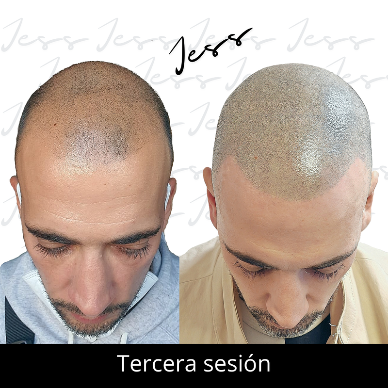 Jess Microcapilar 11