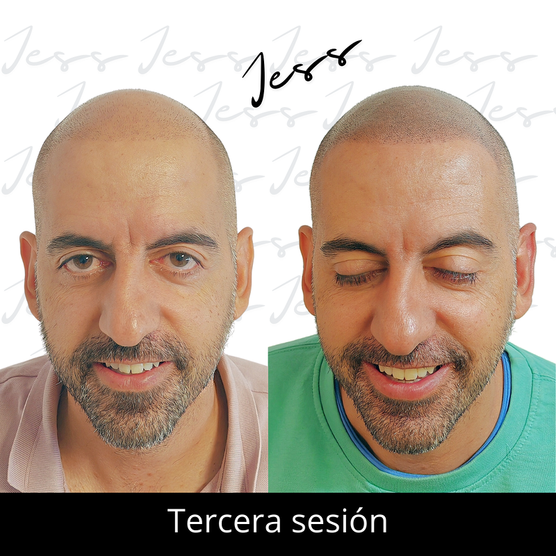 Jess Microcapilar Alcorcón