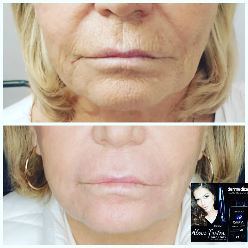 Alma Micropigmentaci&oacute;n 11