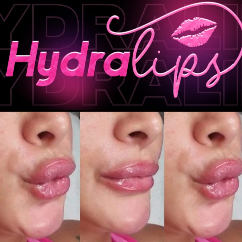 Isa Martín Láser y Estética 3