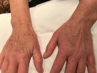 Centro Dermatológico Dr. Javier Bassas Bresca Barcelona Centro Dermatológico Dr. Javier Bassas Bresca Barcelona